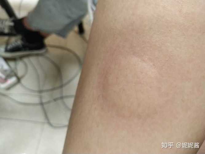 阿明给蚊子咬了一大一小的包,资源管理视角下的启示