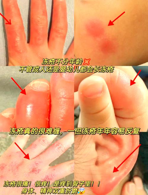 第九所冻伤怎么解决?冻伤解决攻略分享